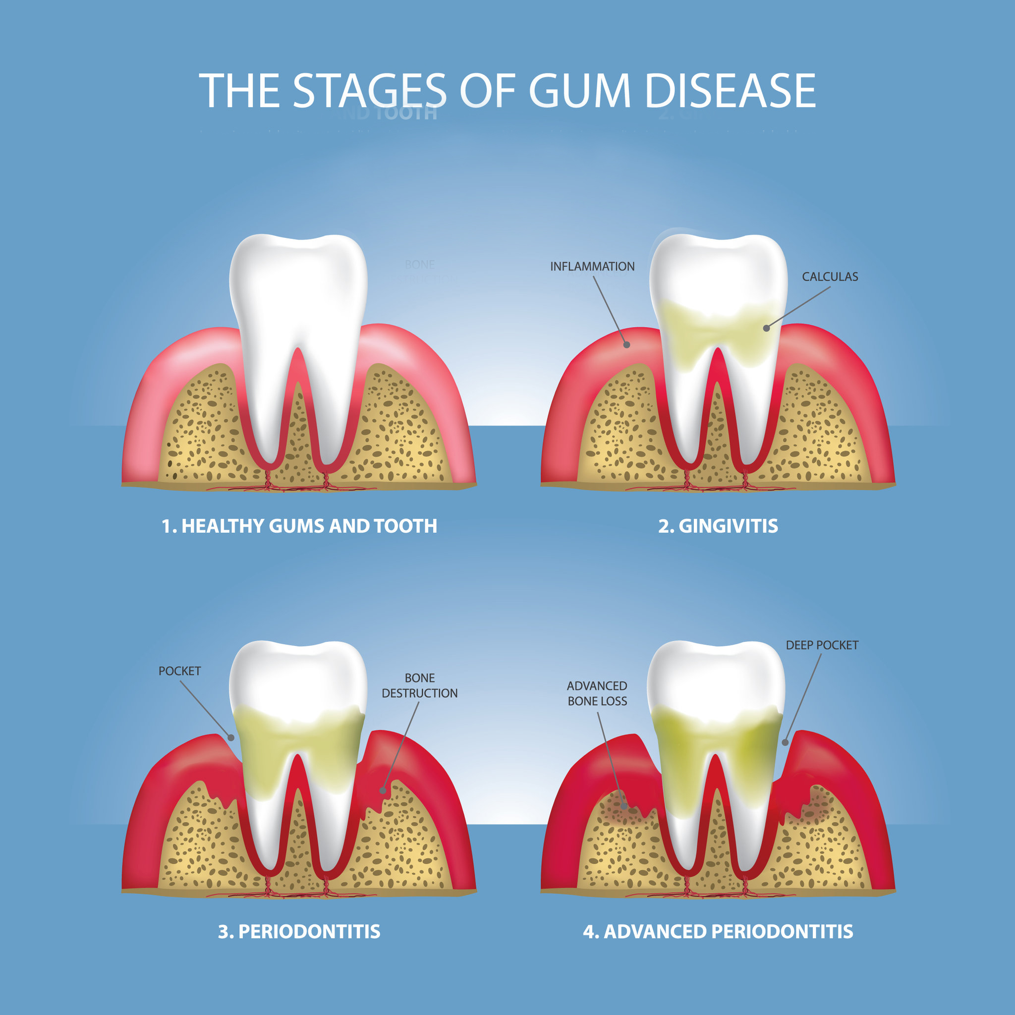 Human teeth Stages of Gum Disease Vector Illustration Illustration showing the four stages of gum disease