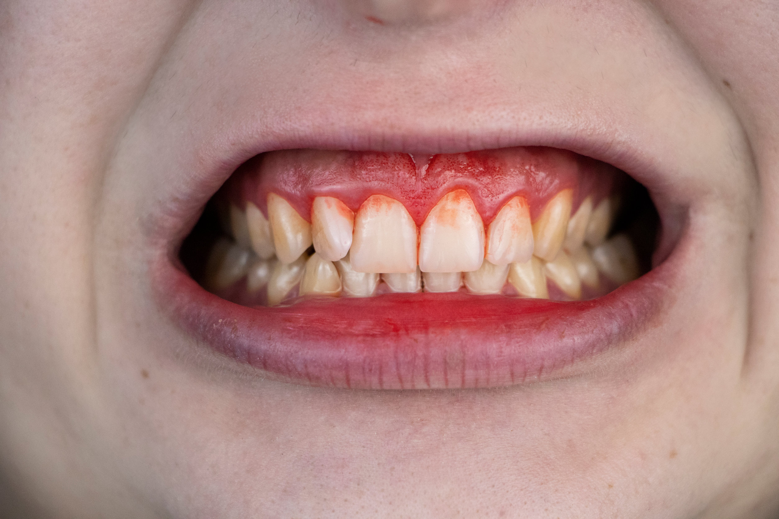 swollen gums Swollen gums indicating periodontal disease